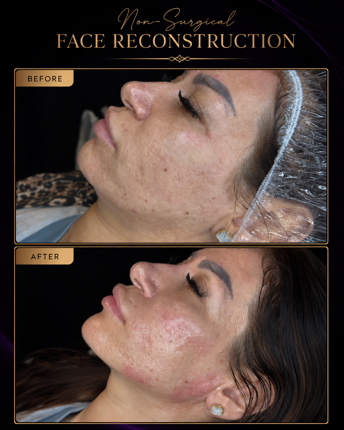 G.Aesthetics 5 ml package before-and-after poster, as featured in Instagram Highlights