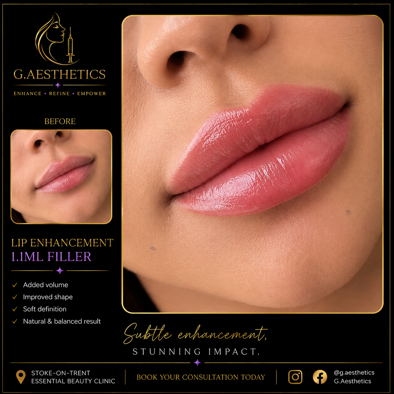 Before and after of a 1.1 ml lip filler enhancement