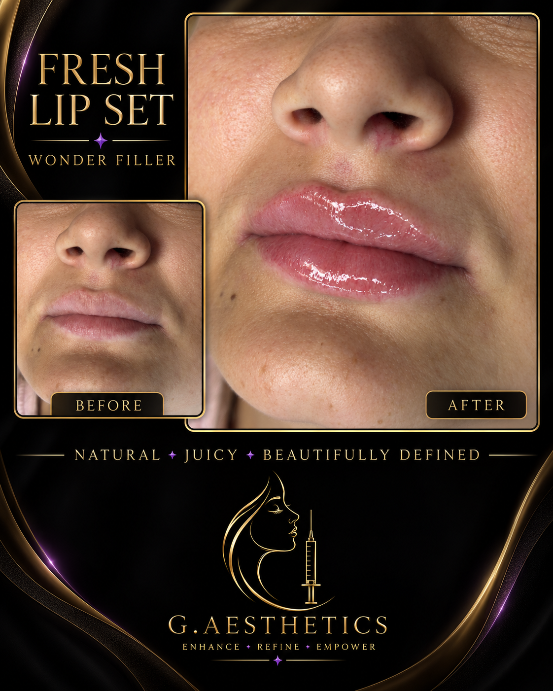 Before and after of a fresh lip filler treatment