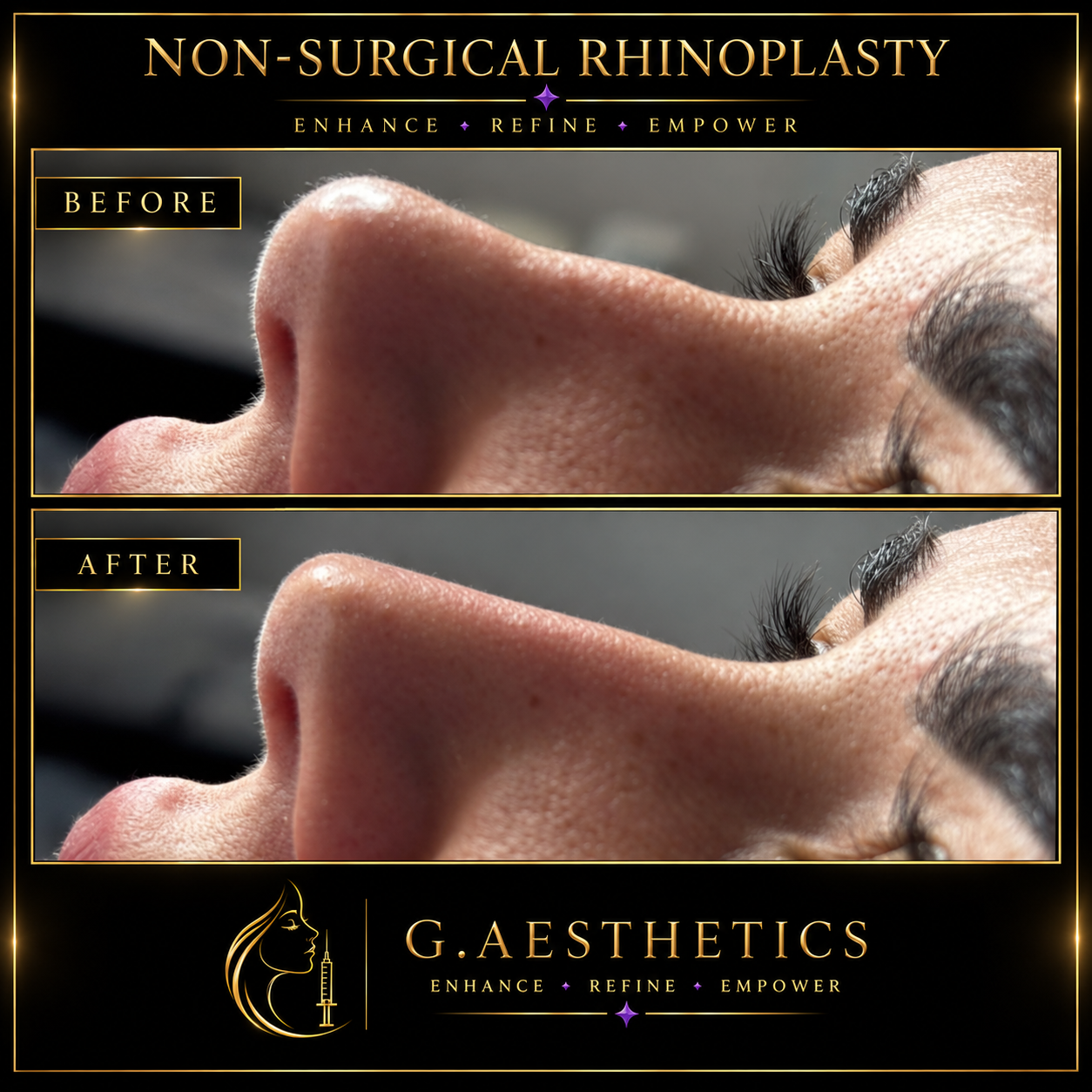 Side-profile before and after of non-surgical rhinoplasty