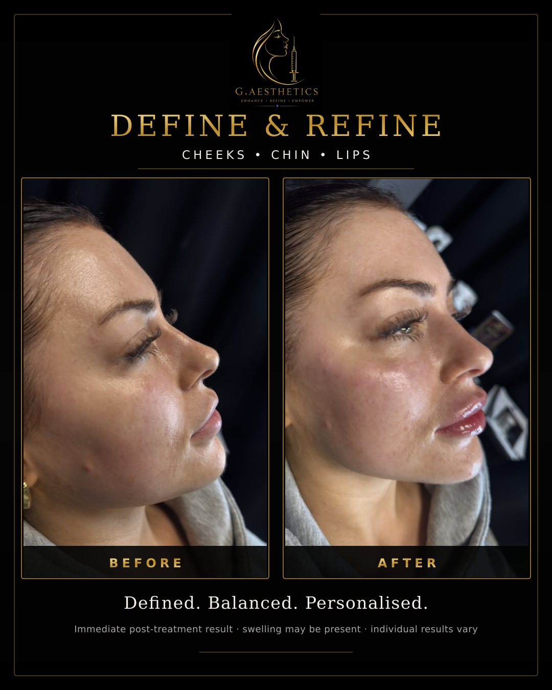 Before and after of the G.Aesthetics Refine and Define cheeks, chin and lips package
